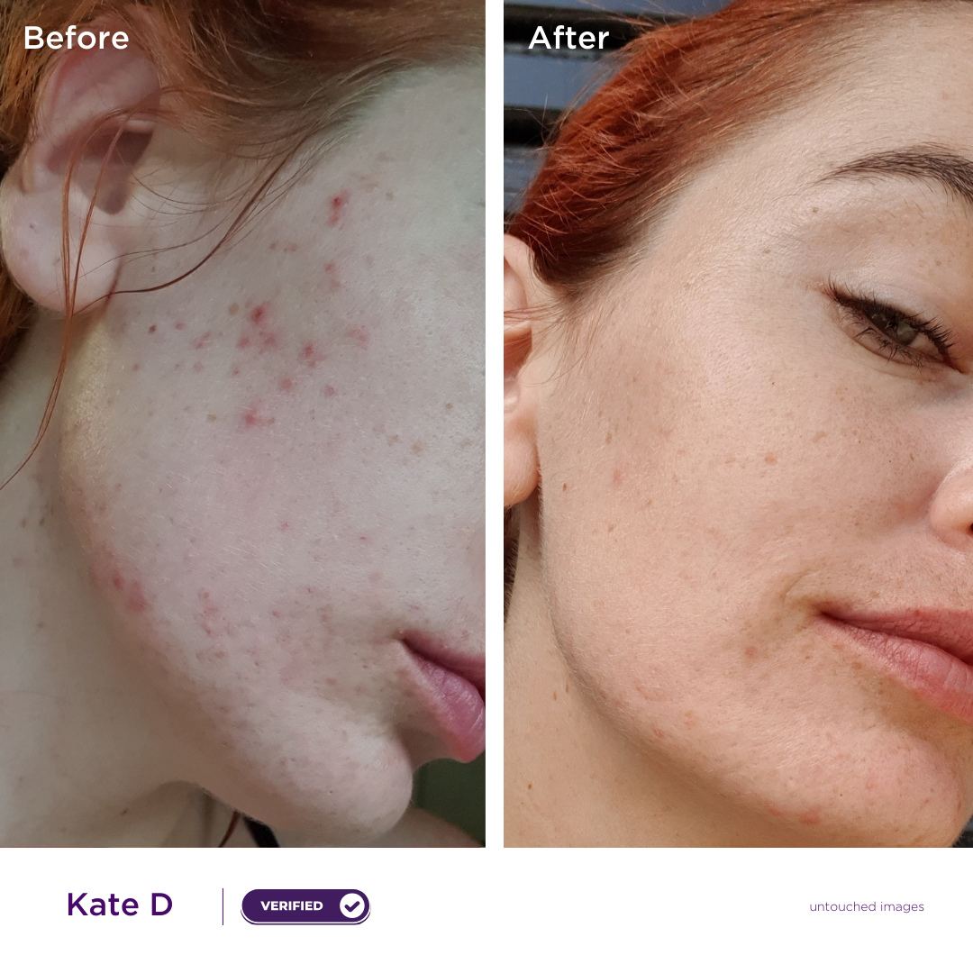 Starter Acne Kit