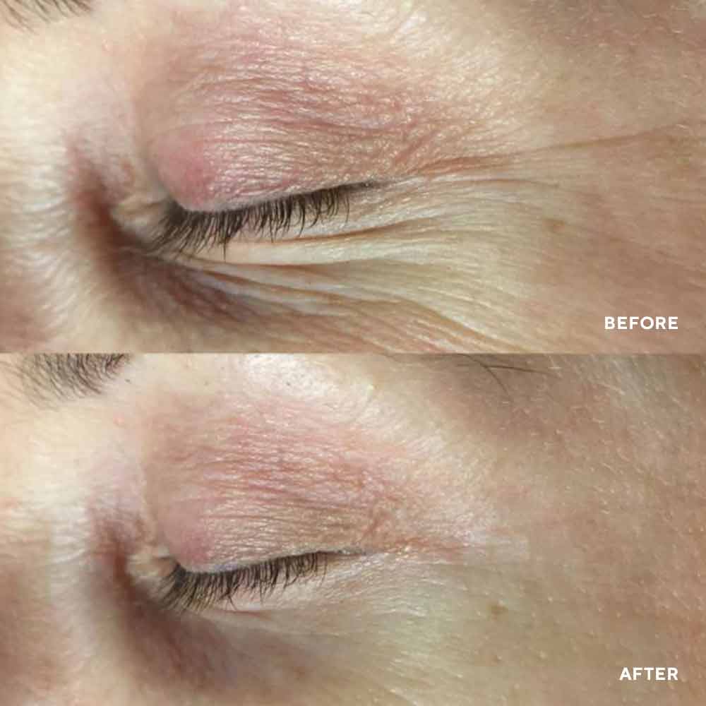 PolyPeptide Collagel Eye