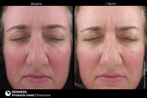 Jan Marini RosaLieve Redness Reducing Complex