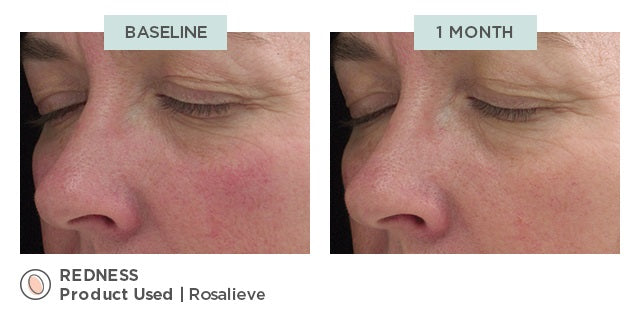 Jan Marini RosaLieve Redness Reducing Complex